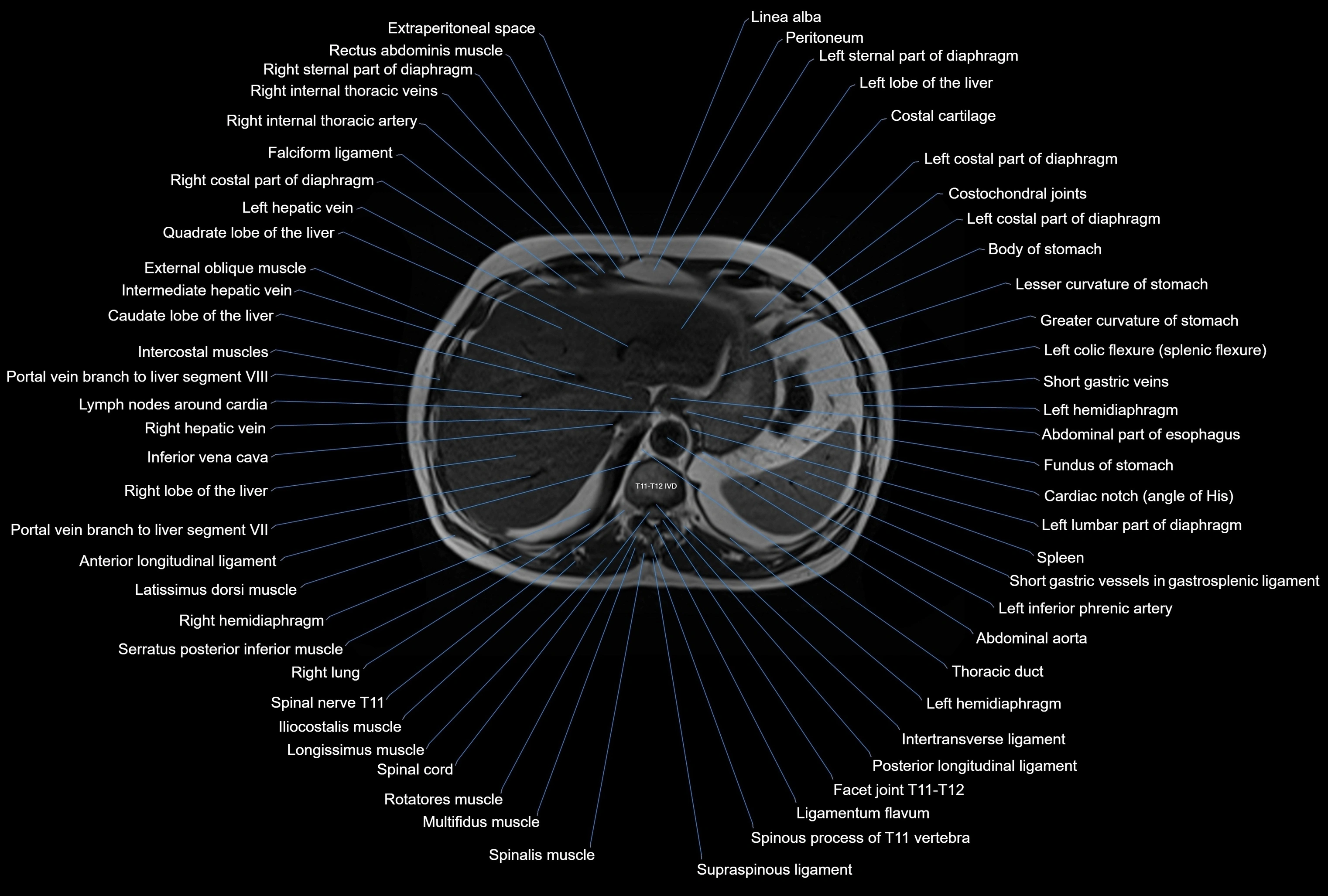 MRI Abdomen axial cross sectional anatomy radiology  image-img-00001-00009.webp